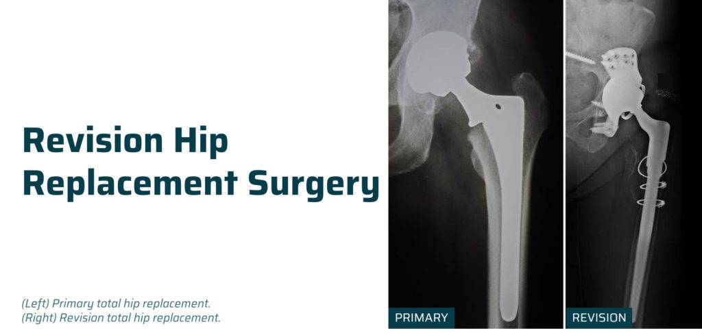 Revision Hip Replacement Surgery | Ahmedabad | Dr. Rachit Sheth