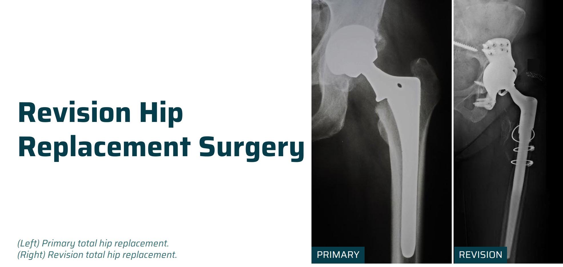 Revision hip replacement surgery