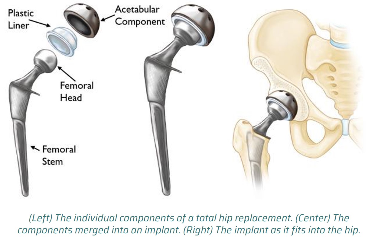hip_replacement_entails