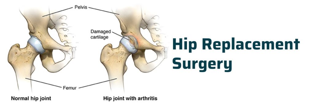 Primary Hip Replacement Surgery Ahmedabad | Dr. Rachit Sheth