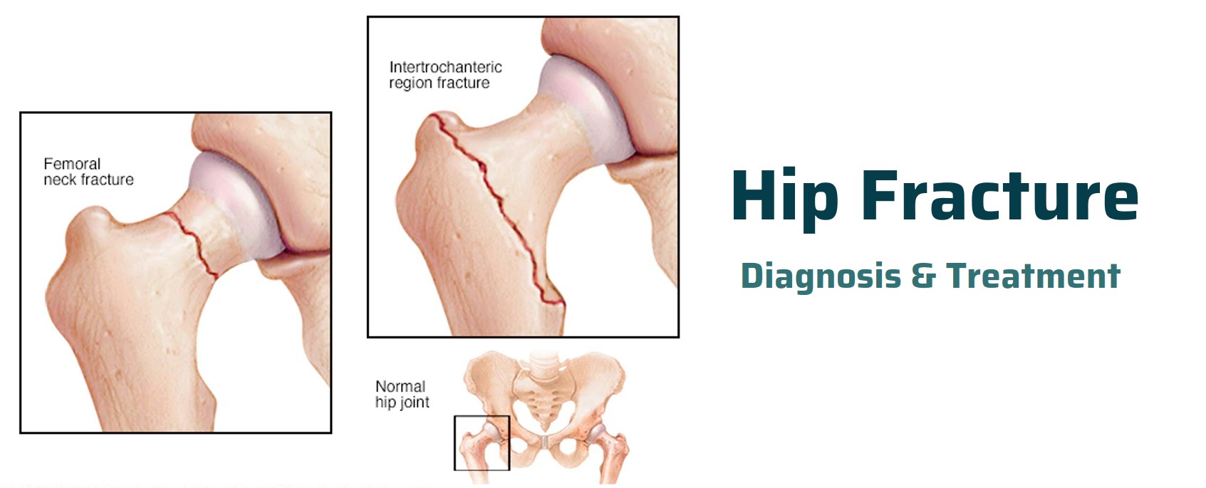 HIP_FRACTURE_MAIN
