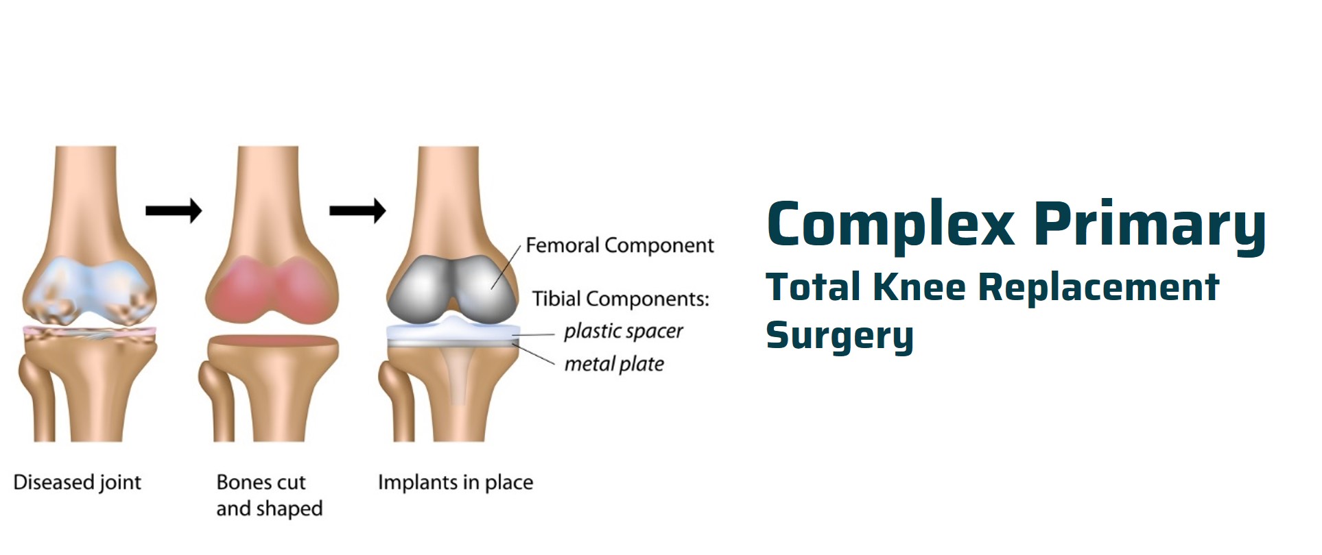 complex_primary_tkr