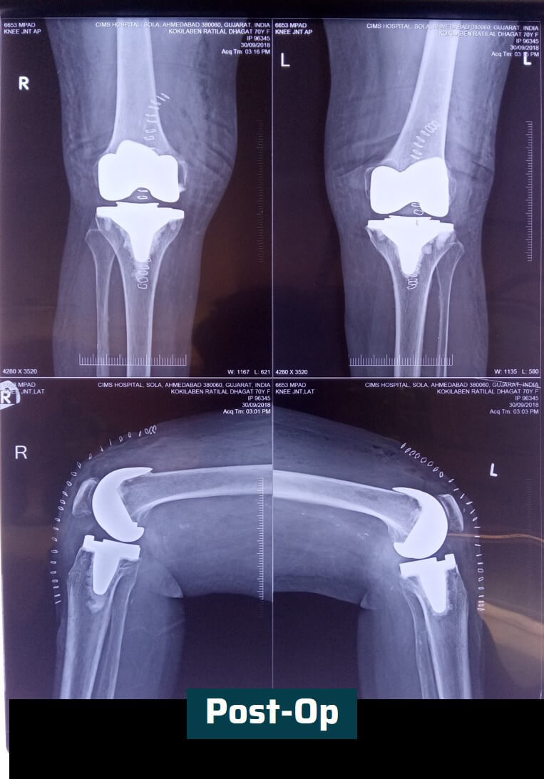 Primary Total Knee Replacement Surgery | Dr. Rachit Sheth