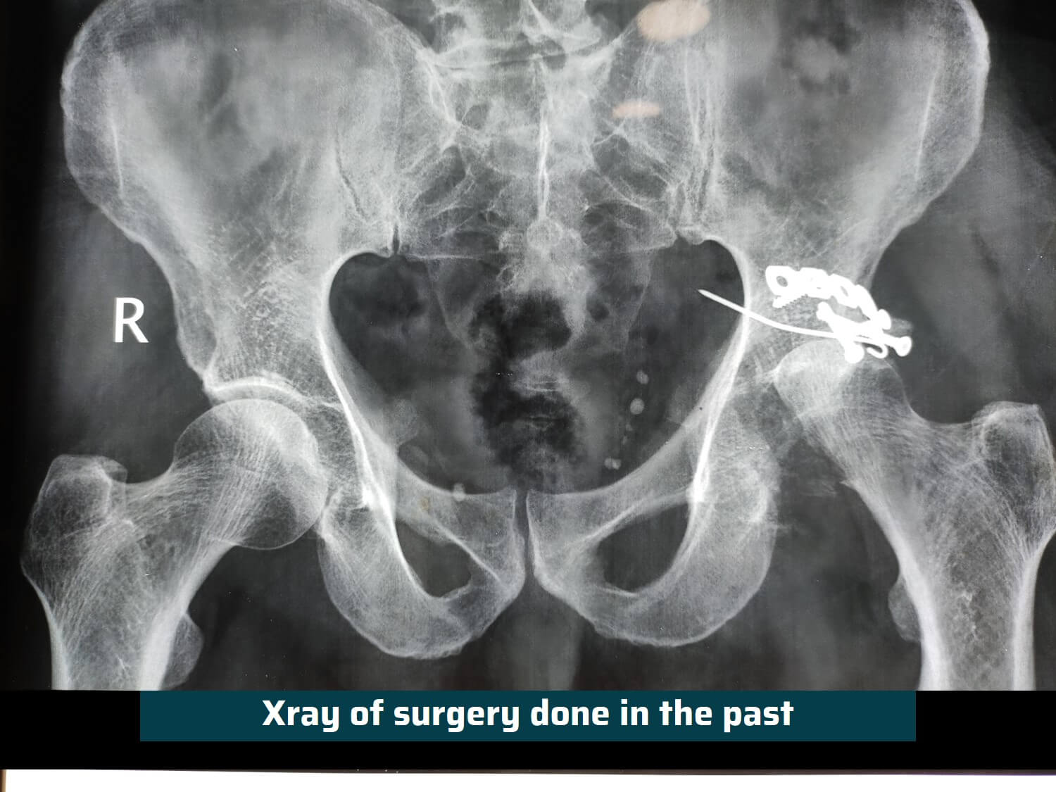 Revision Hip Replacement Surgery Ahmedabad Dr. Rachit