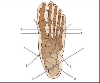 Complex Foot deformities