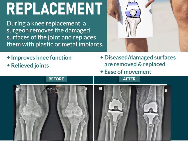 Benefits of Total knee replacement surgery