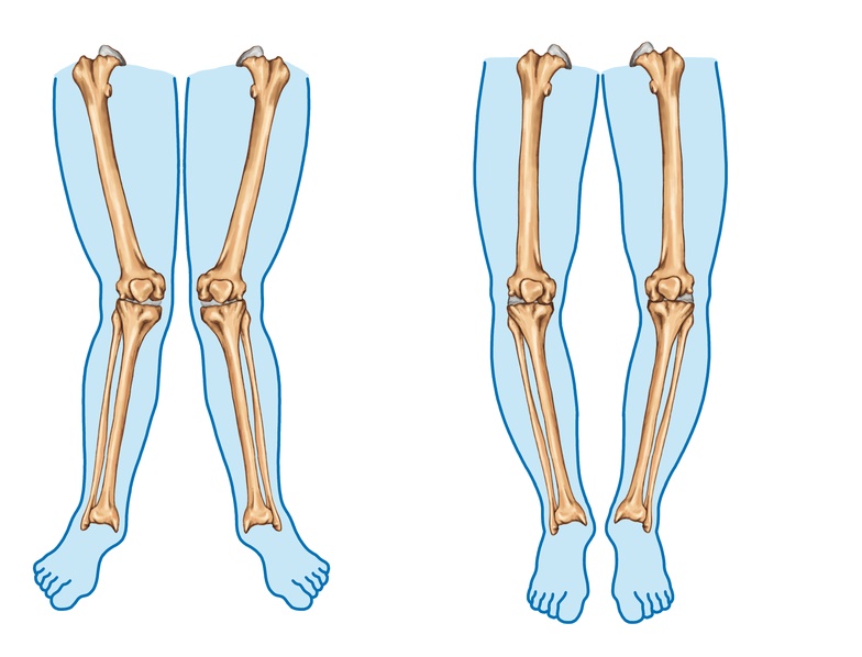 Deformities-around-knee