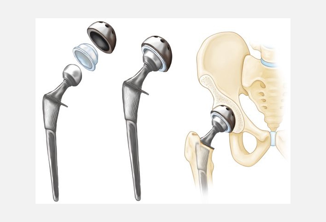 Joint Replacement