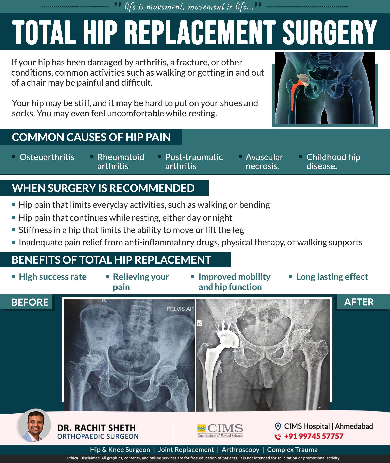 Total Hip Replacement Surgery Procedure & Causes in Kochi