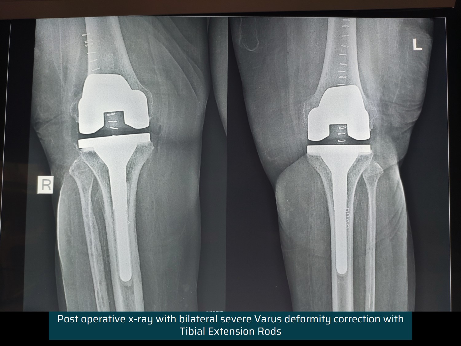 Complex Primary Total Knee Replacement Surgery Dr Rachit Sheth 3342