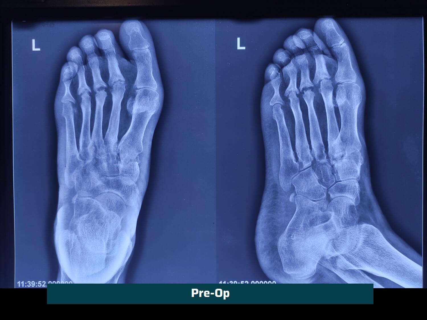 Deformity Corrections | Knee & Foot | Dr. Rachit Sheth