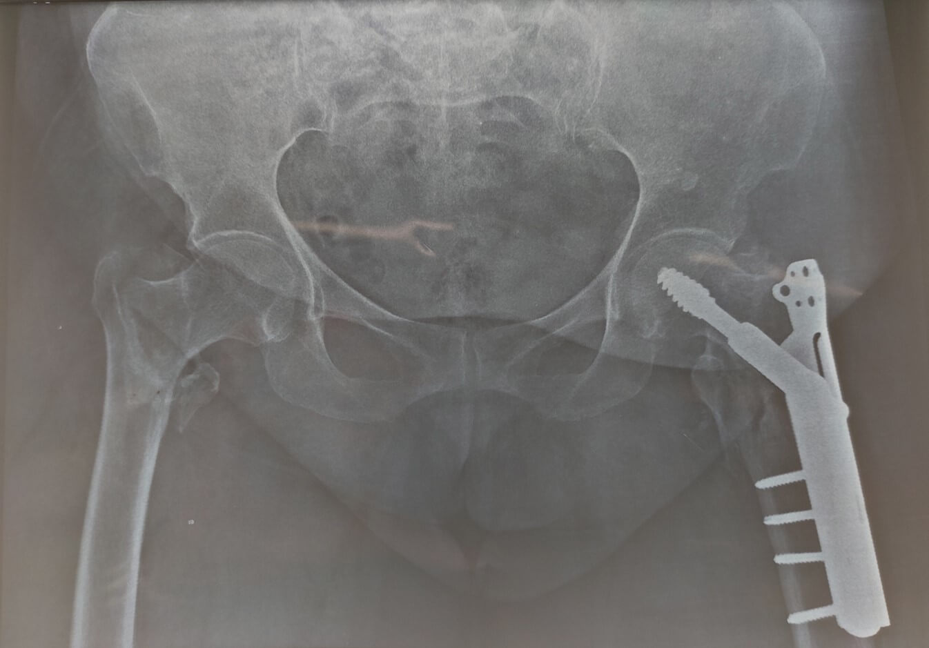 Hip Fractures Surgery in Ahmedabad | Dr. Rachit Sheth