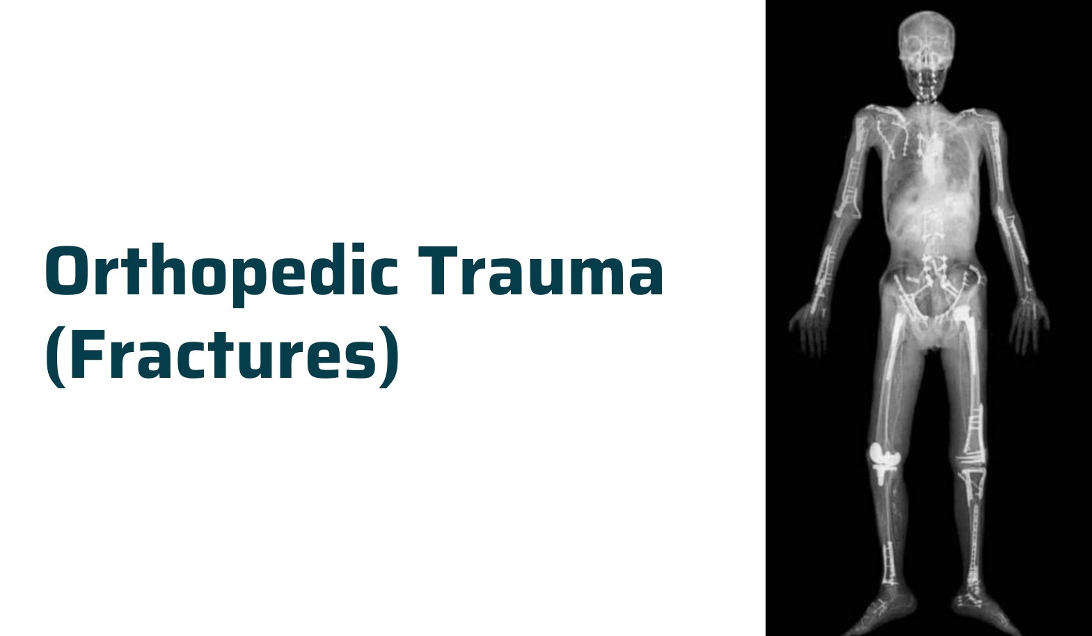 Orthopedic Trauma (Fracture) - Dr. Rachit Sheth