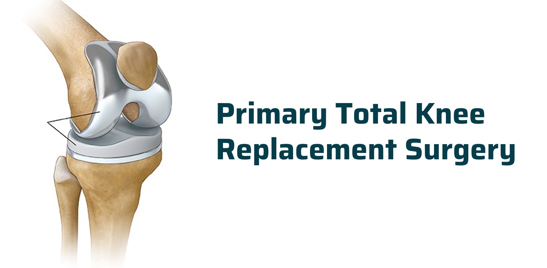 Primary Total Knee Replacement Surgery