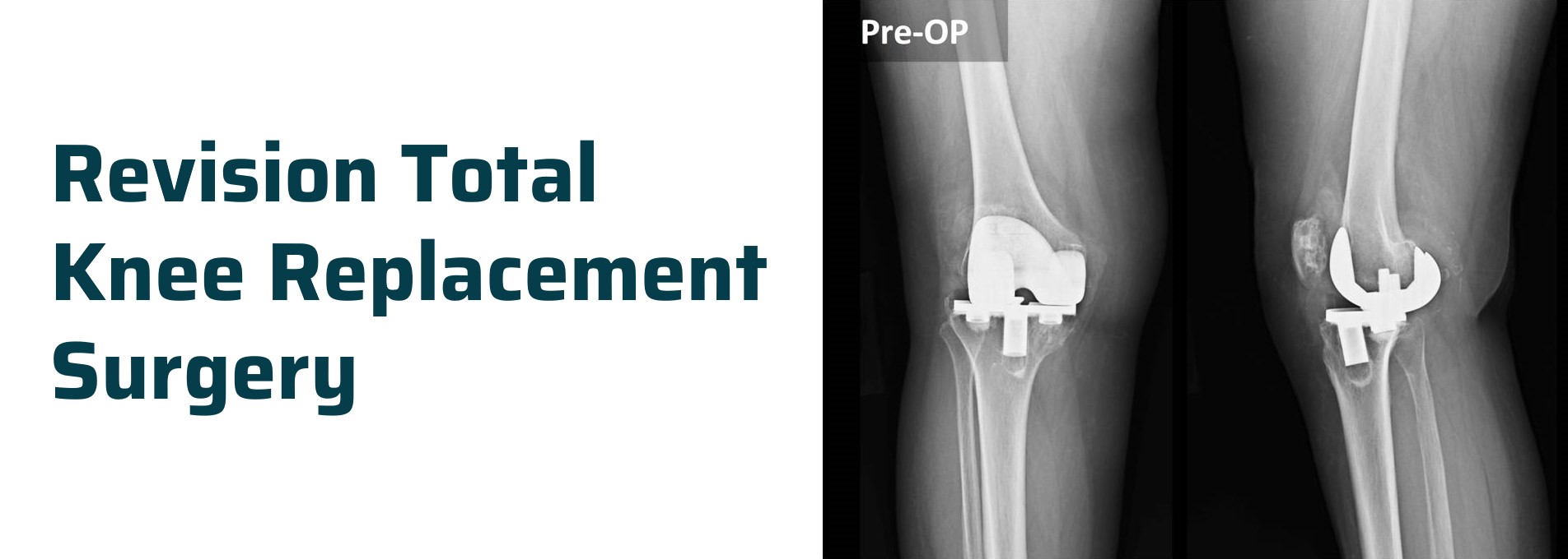 Revision Total Knee Replacement Surgery Ahmedabad Dr Rachit Sheth