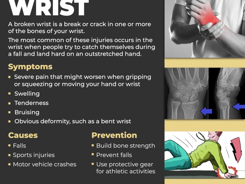 Broken Wrist - Causes and Prevention