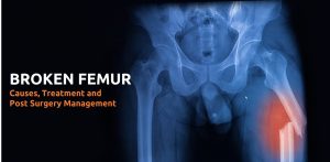 compound femur break