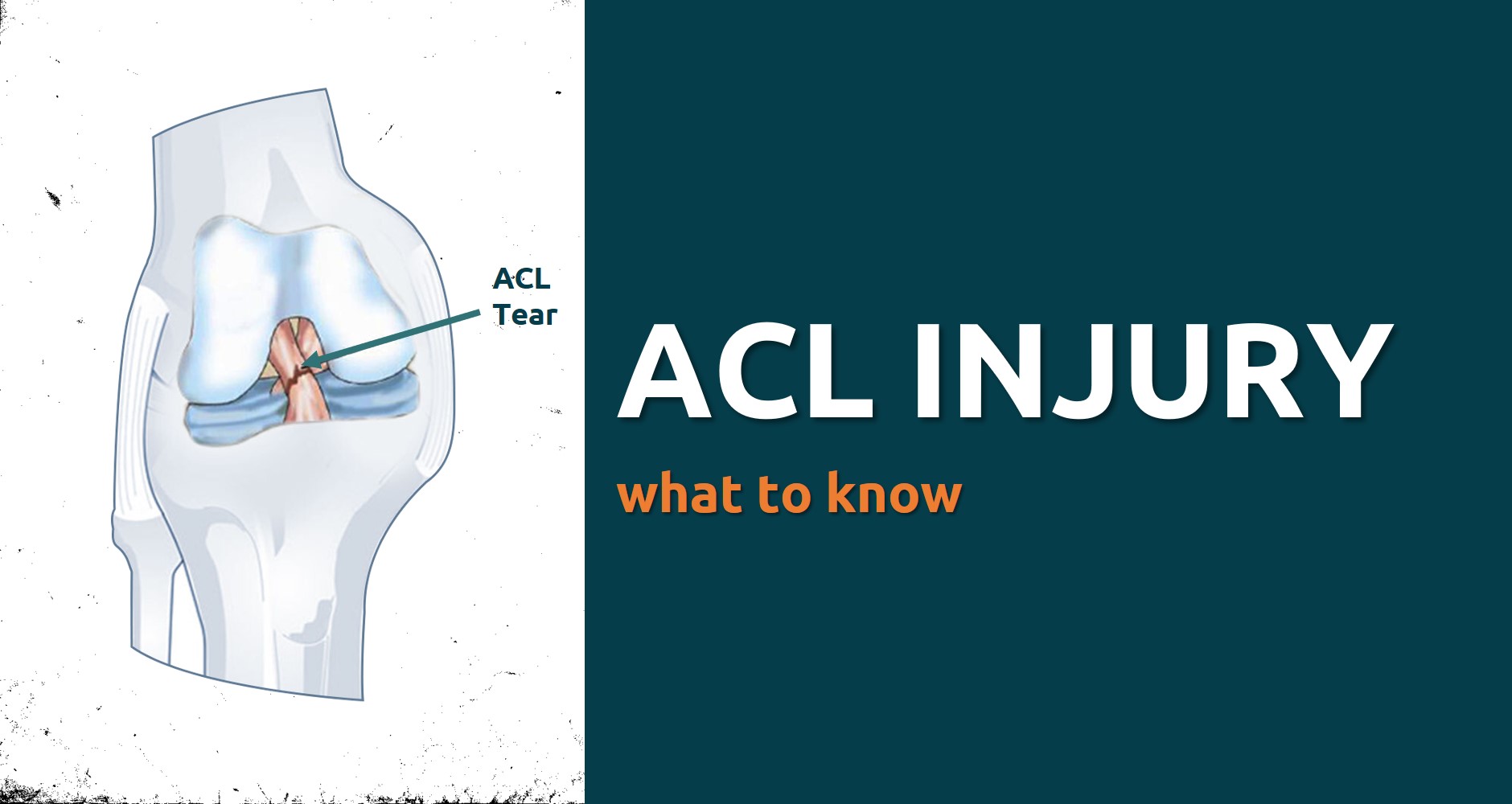 ACL Tear & Injury: Symptoms & Recovery