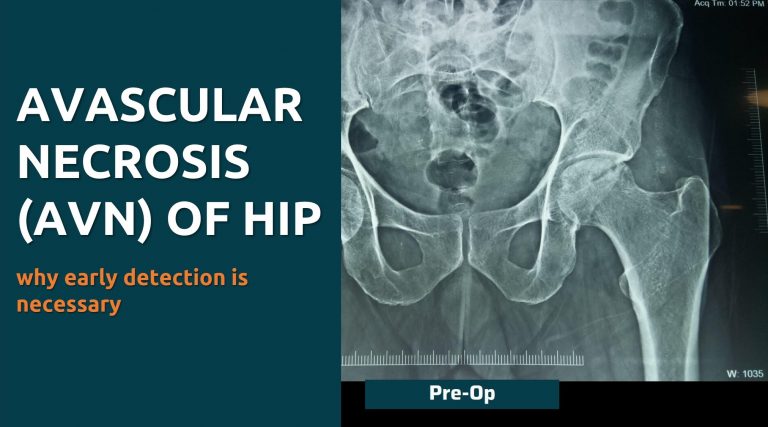 Avascular Necrosis (AVN) of Hip – Why Early Detection is Necessary - Dr ...
