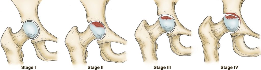 stages of AVN