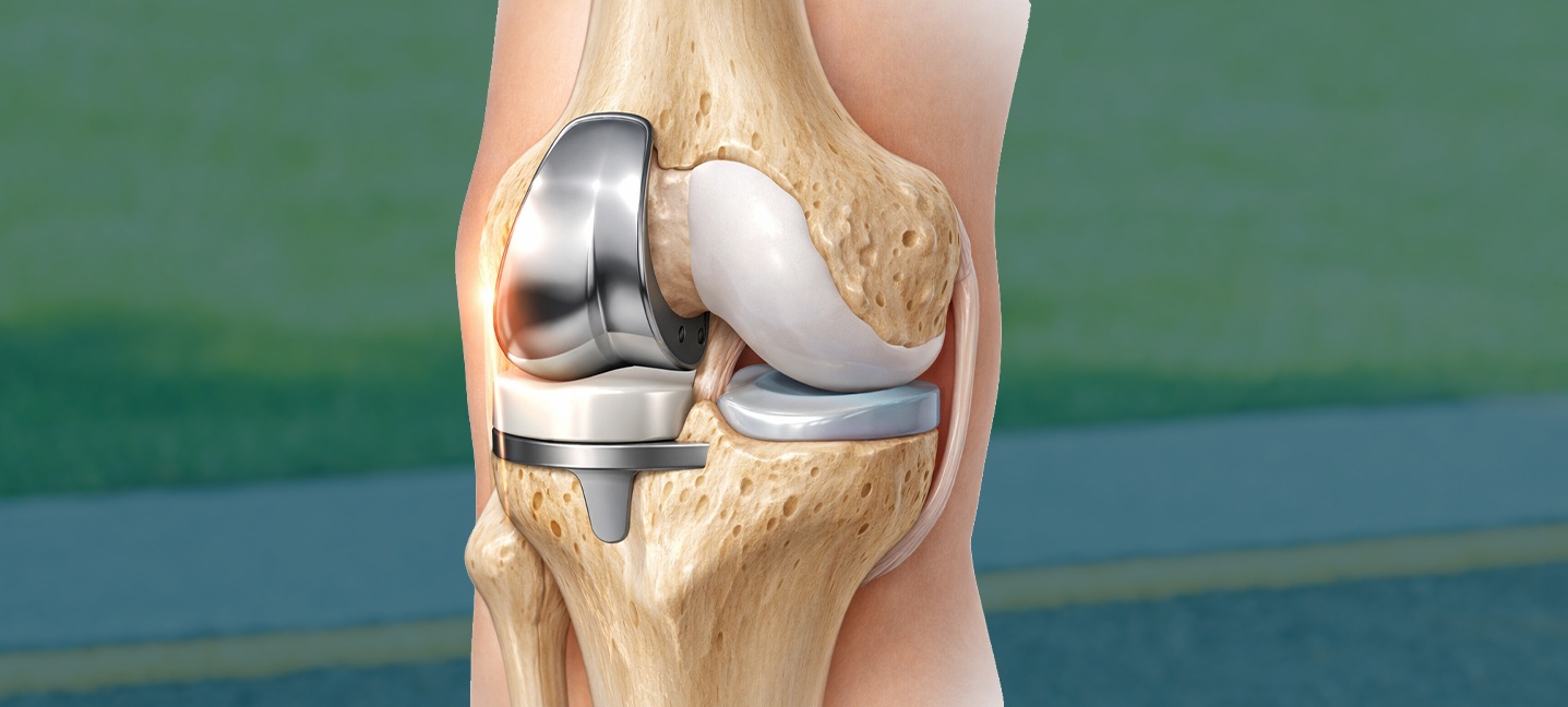 Partial Knee Replacement (Microplasty) in Ahmedabad | Dr. Rachit Sheth